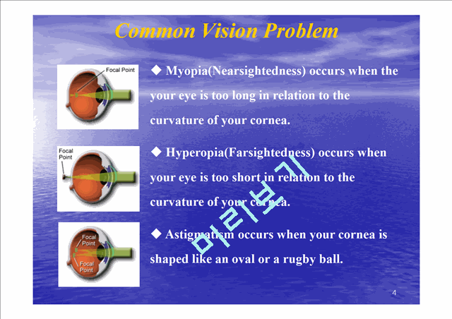 Refrative Laser Eye Surgery   (4 )